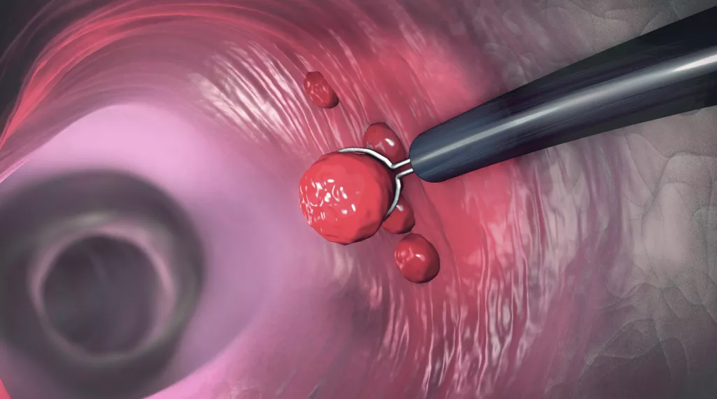 A colorectal polyp being removed by a colonoscope's snare. 