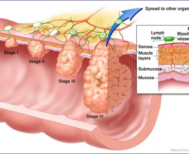 illustration of colorectal cancer stages