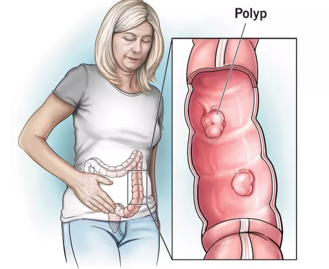woman with colon polyps medical illustration 