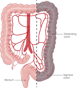 A graphic illustration of a left hemicolectomy. 