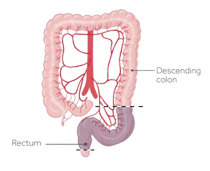 A graphic illustration of a low anterior resection or LAR. 