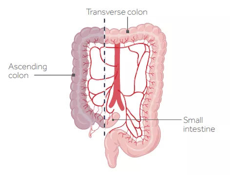 A graphic illustration of a right hemicolectomy surgery. 