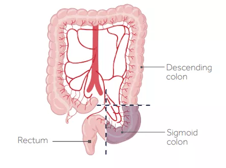 A graphic illustration of a sigmoid colectomy. 